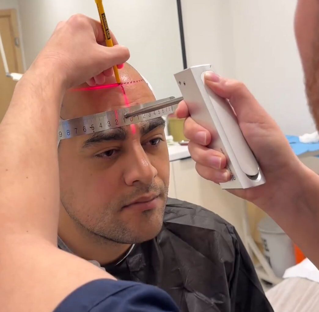 male-going-through-follicular-unit-extraction-process-scaled-measuring.jpg-e1704695560236 (1)